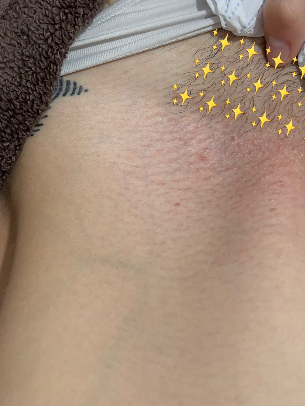 Bikini line straight after a wax