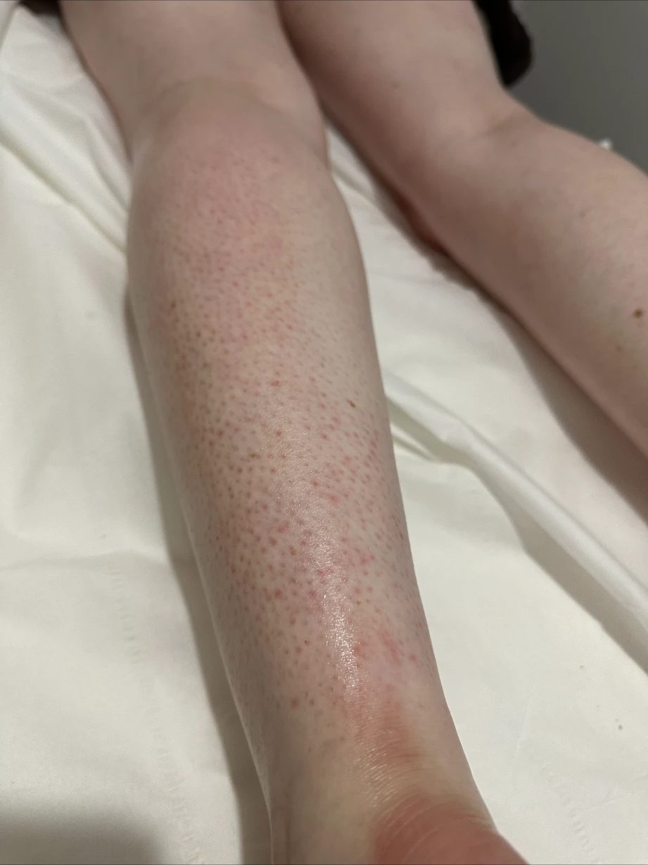 Lower leg straight after a wax, smooth with light redness